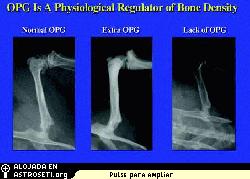 <i>La OPG podr�a ser una eficaz contramedida a la p�rdida �sea experimentada por los astronautas y por pacientes con osteoporosis.</i> 
