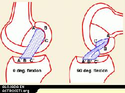 <i>Localizaci�n del ligamento anterior cruzado entre el f�mur y la tibia. El dibujo a la derecha muestra c�mo el ACL puede ser girado y desgarrado (de �Los ligamentos cruzados de la rodilla�, Girgis F.G., Marshal J.L., St.Monajem A.R.S.: Clin Orthop 1975, 106:216-231)</i>
