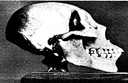 �Lesotho_microcephalic�